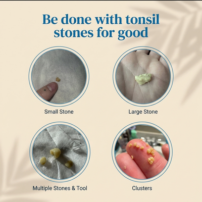 Oralieve Tonsil Stone Cleaner